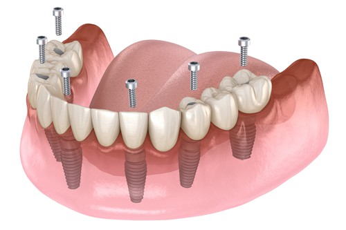 Zubní implantáty a náhrady