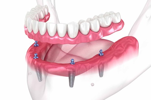 Zubní implantáty a náhrady