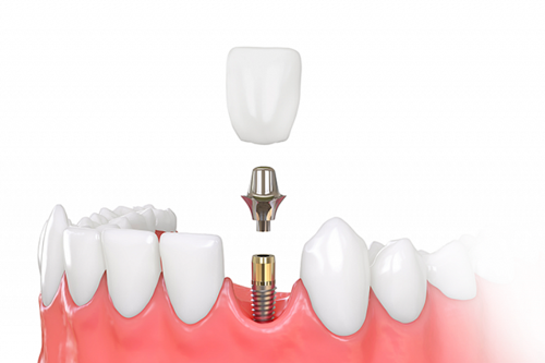 Zubní implantáty a náhrady